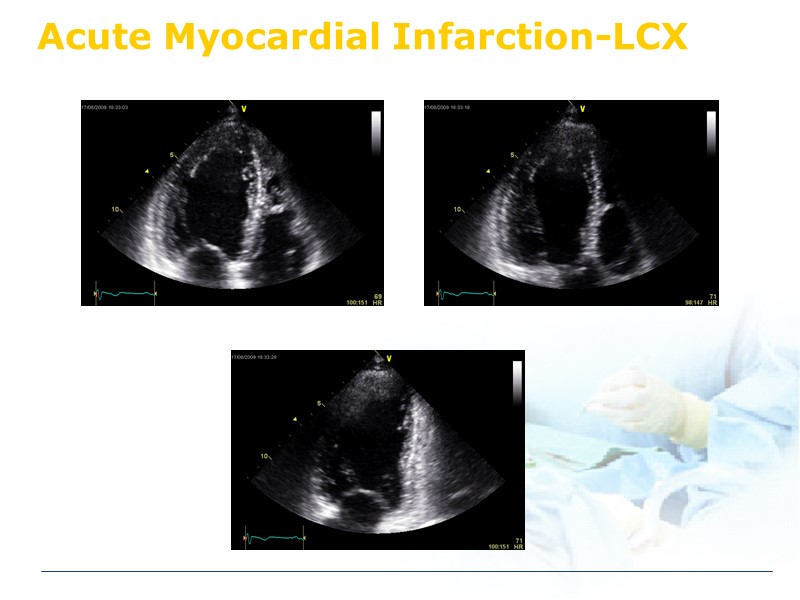 Acute Myocardial Infarction-LCX